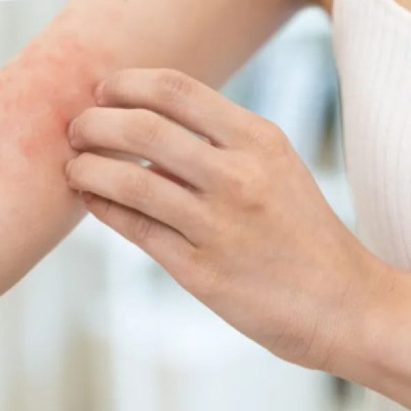 atopowe zapalenie skóry