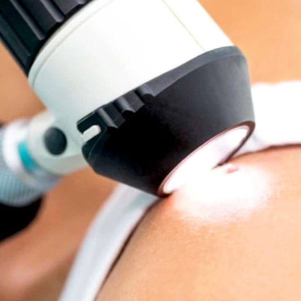 dermatoskopia