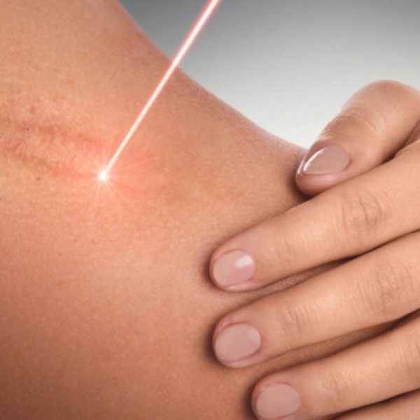 laserowe usuwanie blizn przebarwień rozstępów