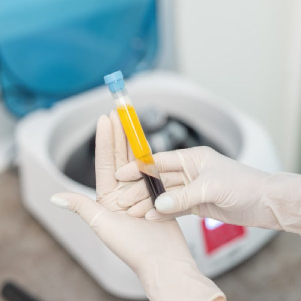 osocze bogatopłytkowe