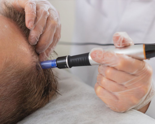 leczenie łysienia