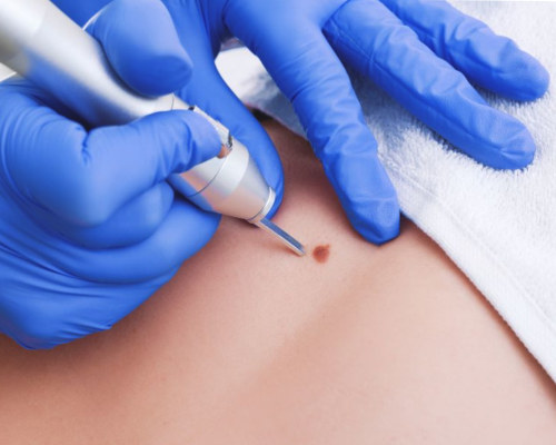 usuwanie pieprzyków