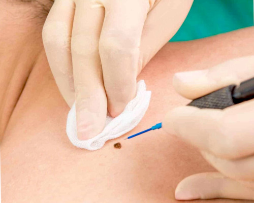 usuwanie włókniaków